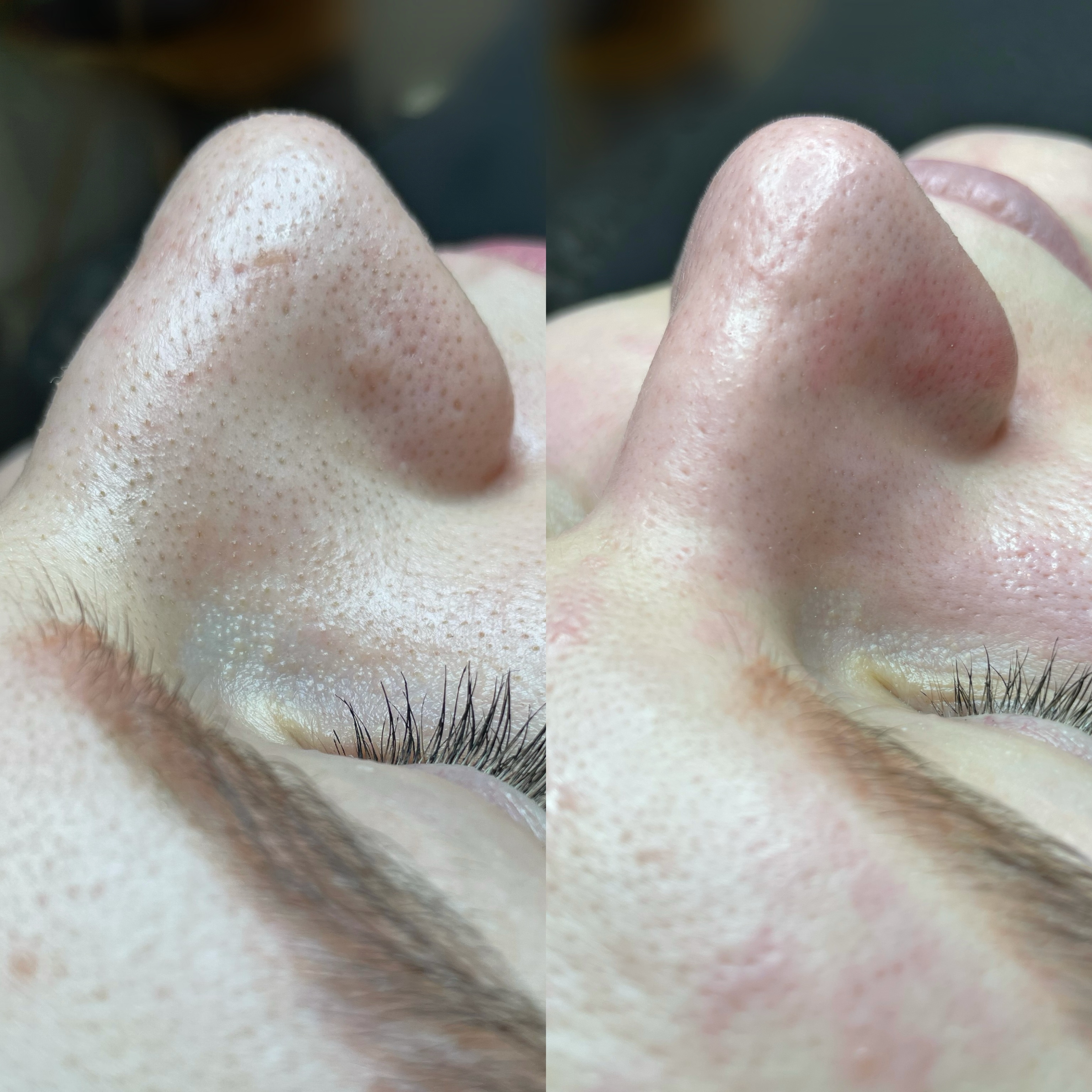 hydrafacial1
