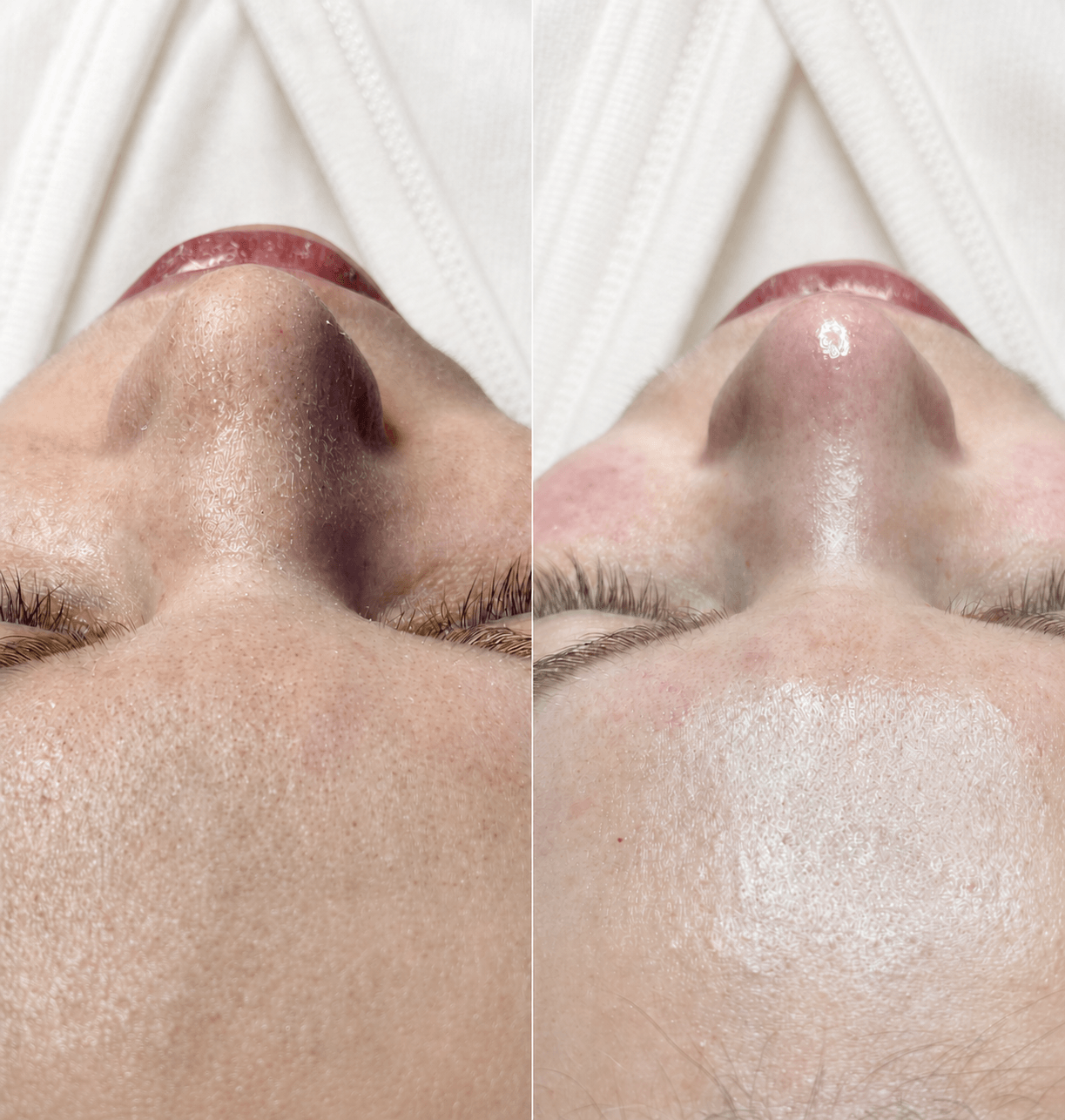 Dermadrop - result